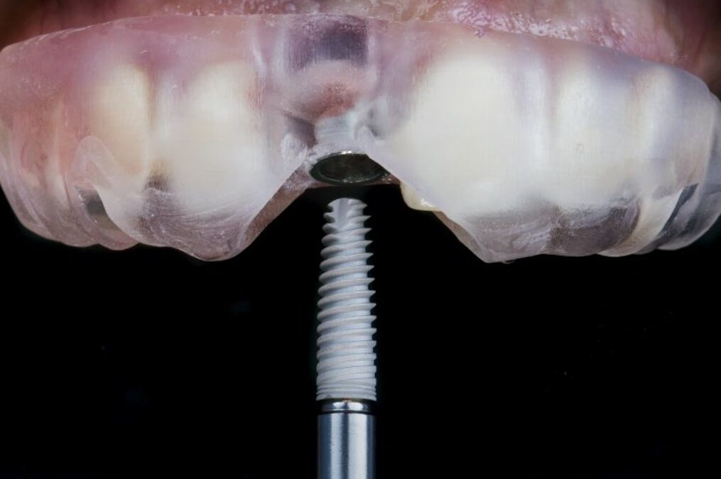 What Is Guided Implant Surgery?